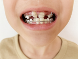 歯の矯正したことある?